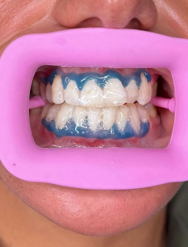 Teeth Whitening